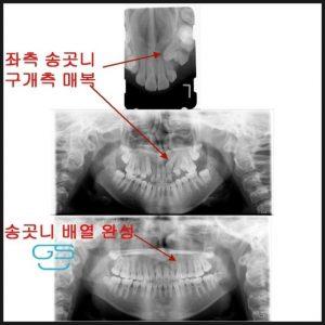 매복 송곳니 교정