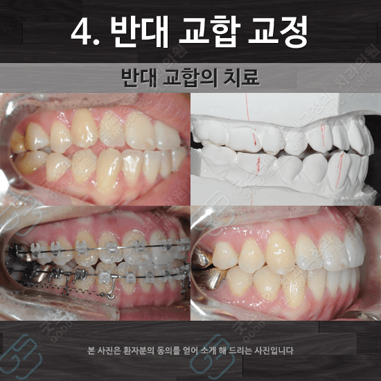 반대 교합 교정