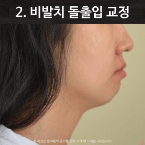 비발치 돌출입 교정