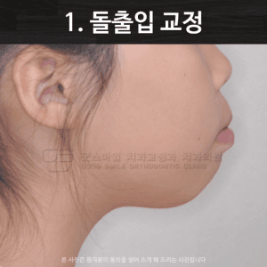 돌출입 교정