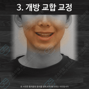 개방 교합 교정