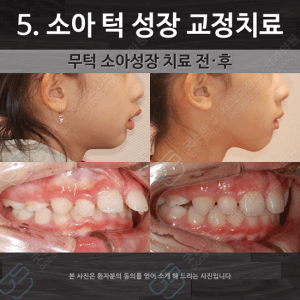 소아 턱 성장 교정