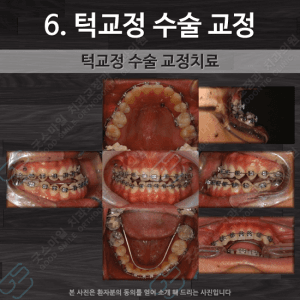 턱교정 수술 교정