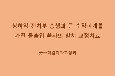 상하악 전치부 총생과 큰 수직피개를 가진 돌출입 환자의 발치 교정치료, 굿스마일치과교정과