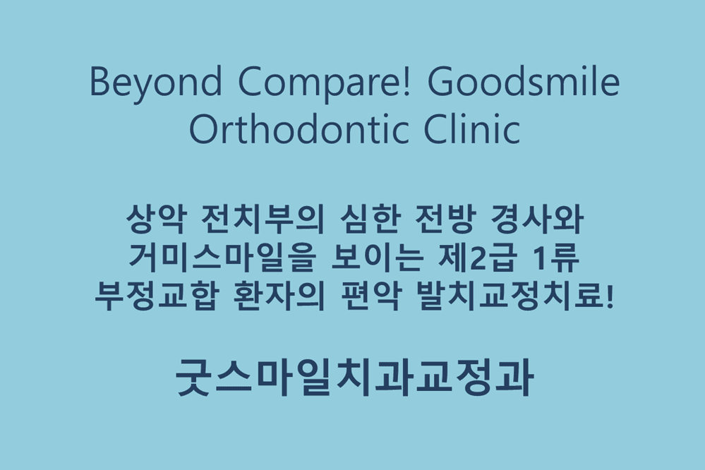 상악 전치부의 심한 전방 경사와 거미스마일을 보이는 제2급 1류 부정교합 환자의 편악 발치교정치료!, 굿스마일치과교정과