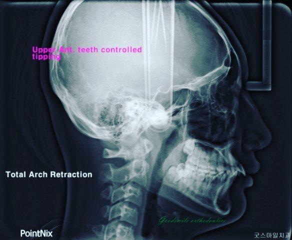 This patient(14Y3M-17Y2M) showed full class II*Left side, half cusp class II*Rig…