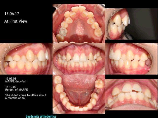 She presented severe malocclusion which included maxillary constriction, #46 mis…