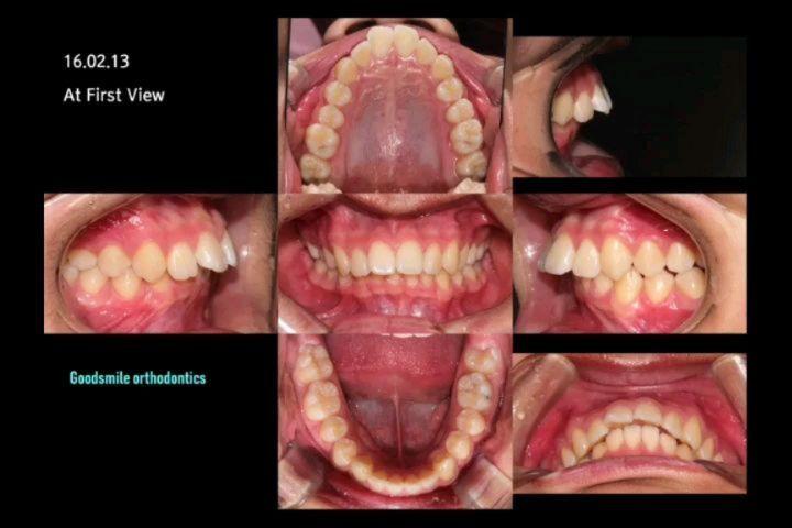 This patient showed full class II*Left side, half …