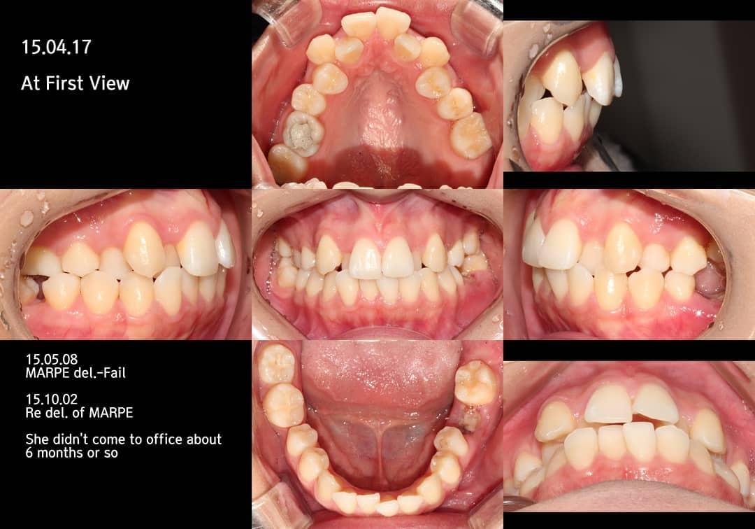Molar protraction to the severely constricted alve…