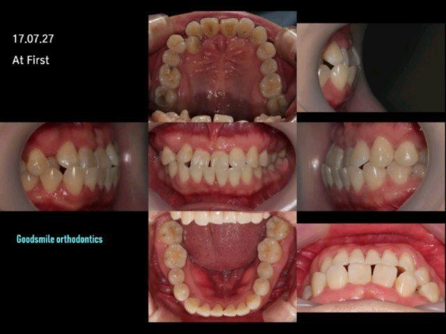 She had Skeletal class III, Dental class III maloc…