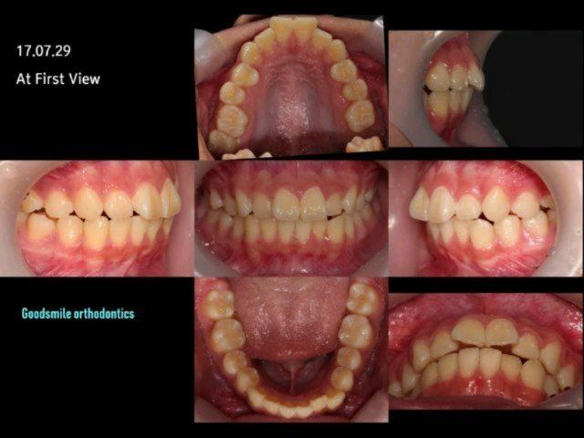 Total arch retraction with MARPE, Non-ext
This gi…