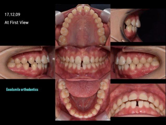 This patient presented spaced dentition. She had g…