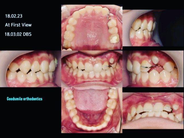 Vertical Canine Impaction treatment
This boy(12Y1…