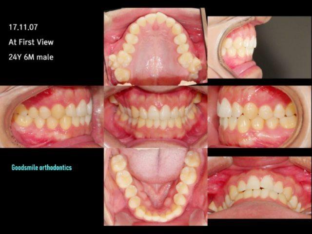 He presented bilateral scissor bite and mild anter…
