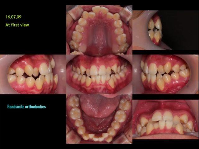 One jaw surgery case of skeletal class III patient…