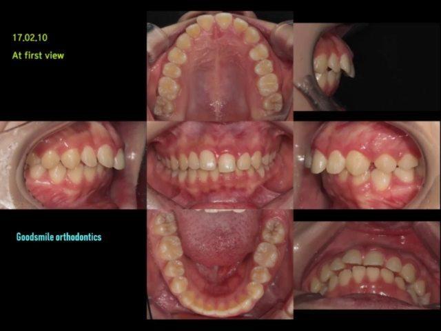 Gummy smile and severe lip protrusion treatment ca…
