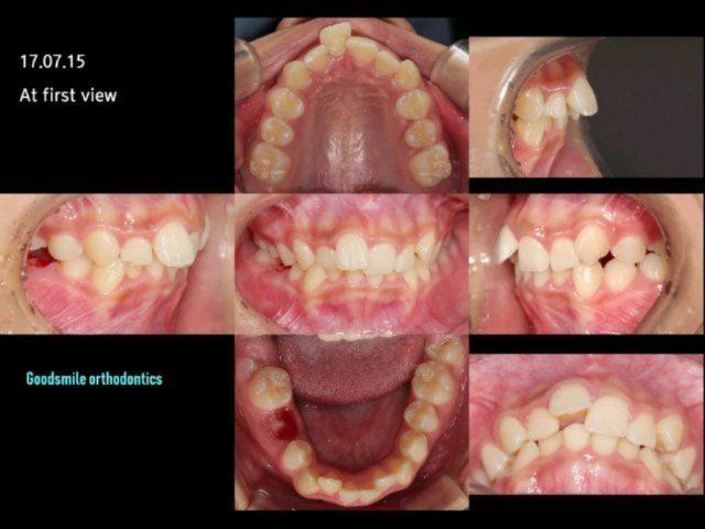 Total Arch Retraction with MARPE, Nonextraction
T…