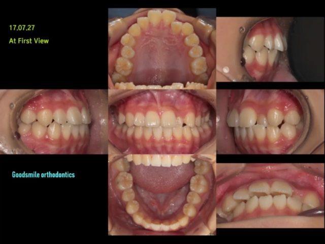 Non ext treatment in Upper moderate crowding case
…