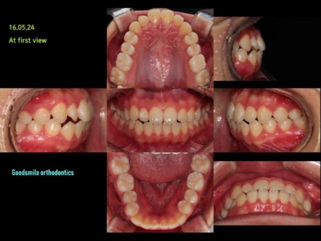Camouflage Treatment of Skeletal Class III maloccl…