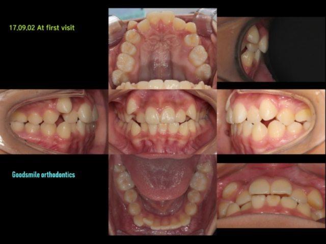 Upper 1st premolars Ext case
This young girl(12Y5…