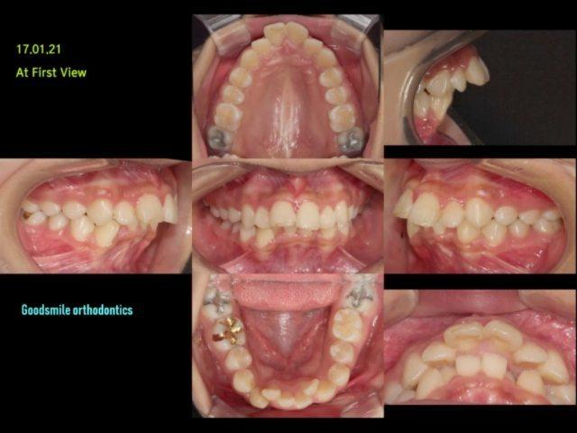 Ext. treatment of severe upper ant. teeth labivers…