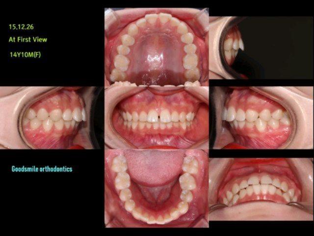 Treatment of lip protrusion patient
This patient’…