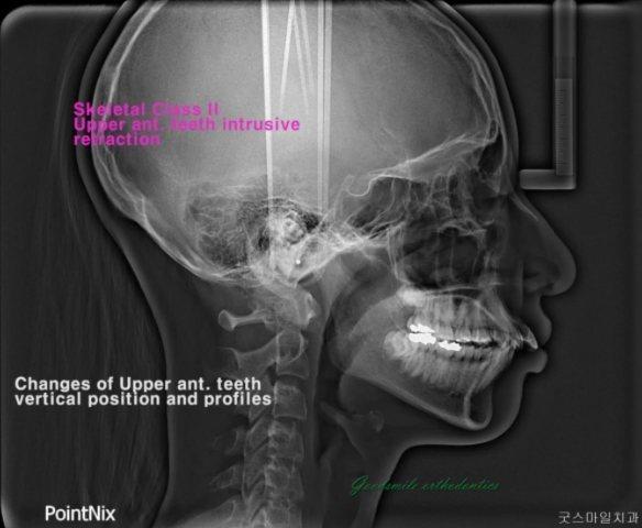 Ext. treatment of severe upper ant. teeth labivers…