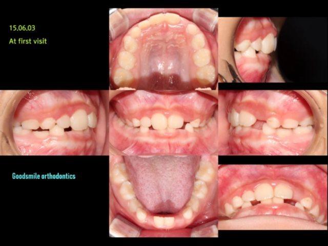 Both arches expansion non-ext tx case
This young …