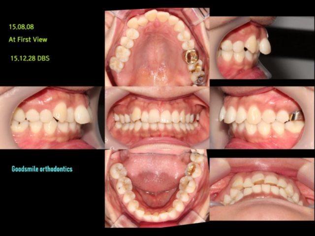 Treatment of lower 3 incisors with dual bite 39Y…