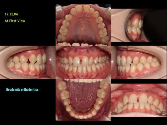 treatment of generalized spacing with congenital m…