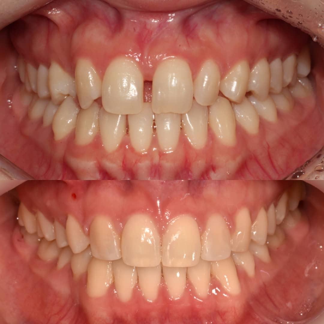 Before and after
#blackshaqgoodsmile #orthodontis…