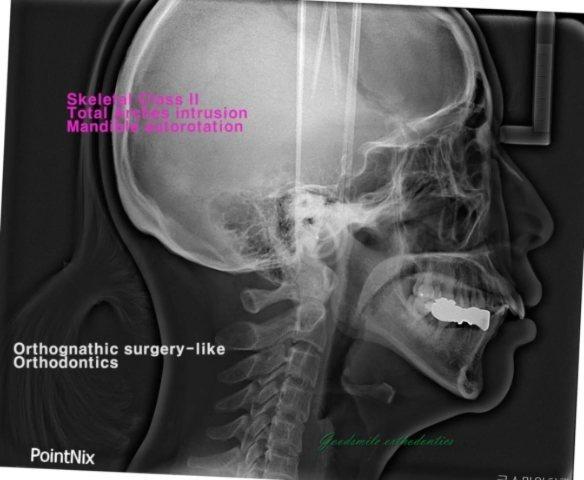 Orthognathic surgery-like orthodontics
This femal…