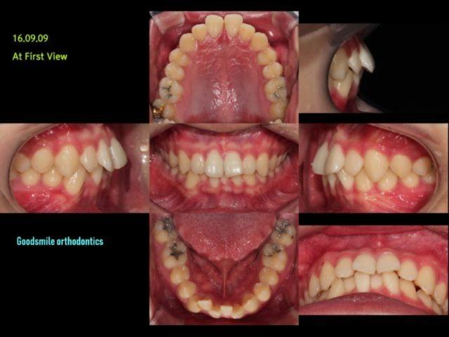 Upper total arch retraction in the dental dysplasi…