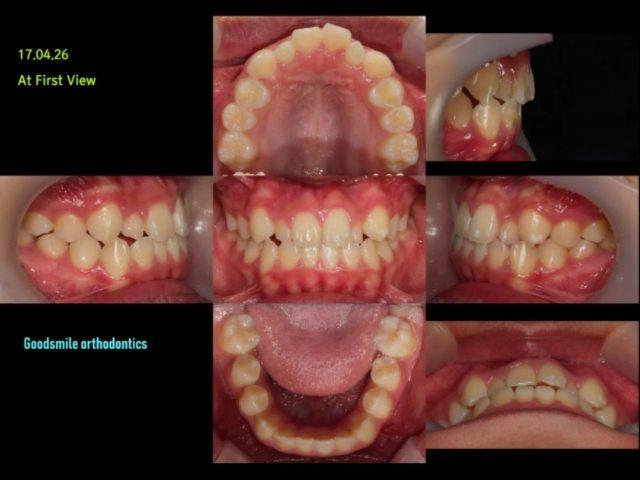 Camouflage treatment of skeletal class III with pe…