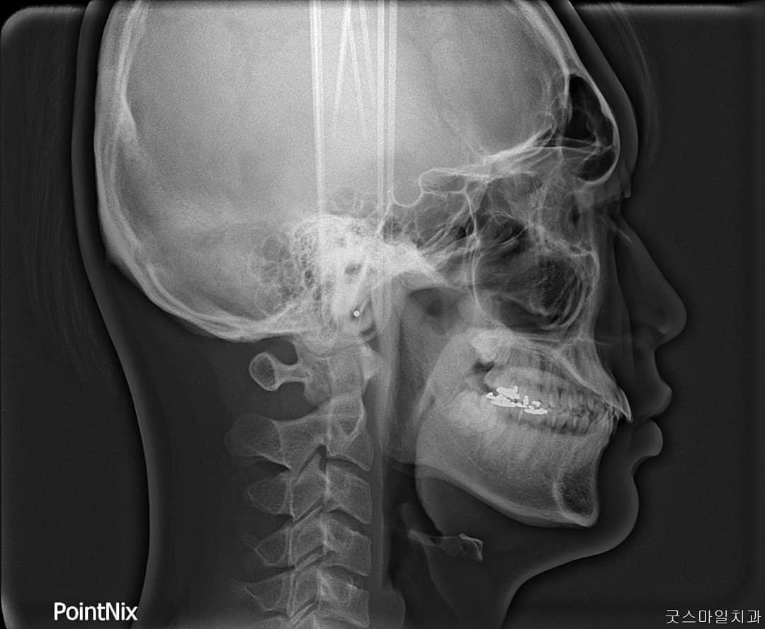 pper total arch retraction in the dental dysplasia…