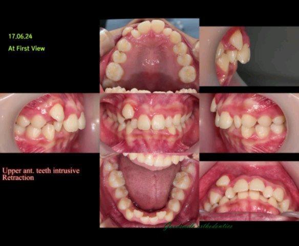 Treatment of skeletal class II patient with ant se…