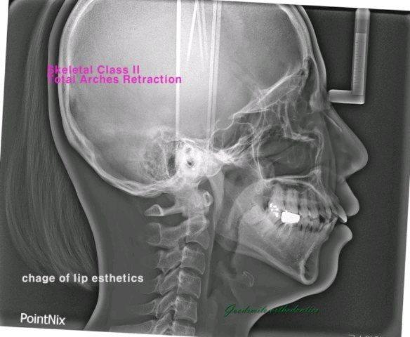 treatment case of skeletal class II dental class I…