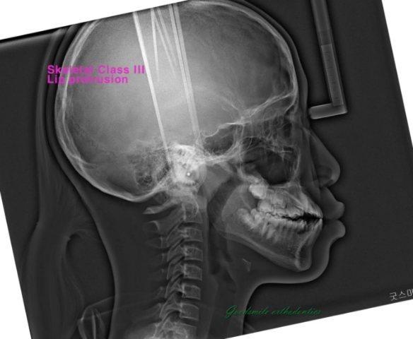 treatment of skeletal class III with lip protrusio…