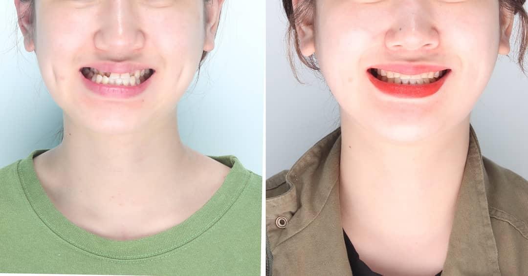 Camouflage treatment of severe mandibular asymmetr…