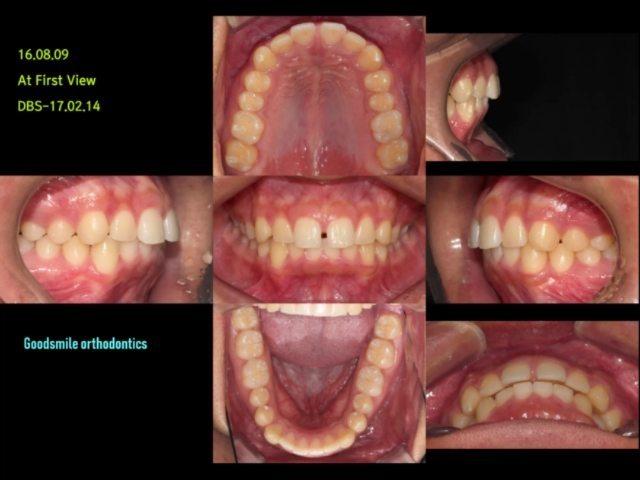 Skeletal class II, Dental class I I malocclusion w…