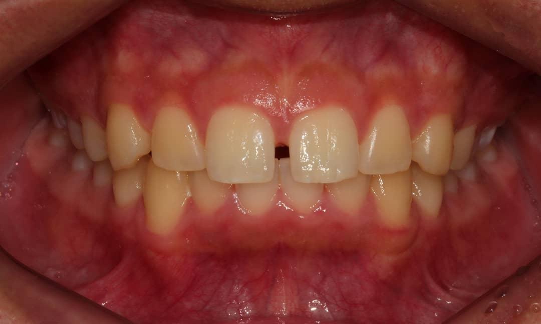 Skeletal Class II, Dental class I and spaced denti…