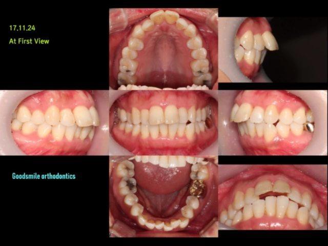 treatment case of skeletal class II dental class I…