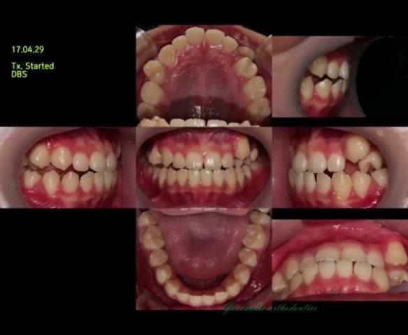 treatment of skeletal class III with lip protrusio…
