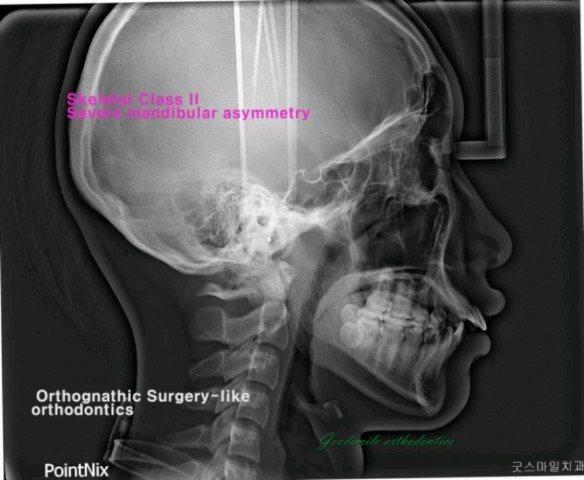Ext case of severe lip protrusion patient with man…
