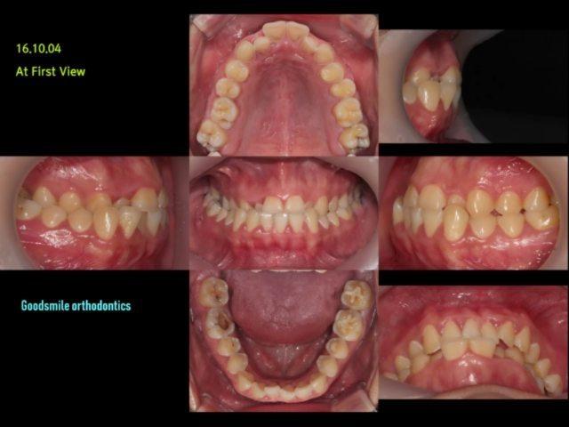 Camouflage treatment of severe mandibular asymmetr…