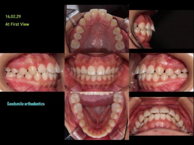 Ext case of severe lip protrusion patient with man…