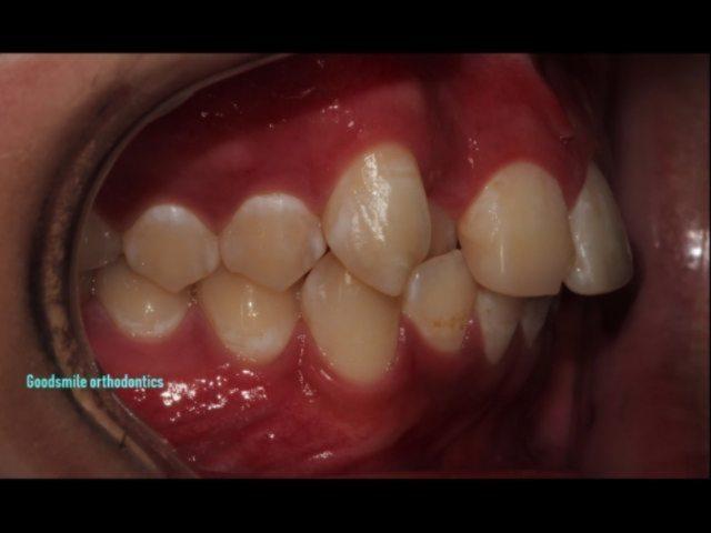 Non-ext treatment of full class II case.How abou…