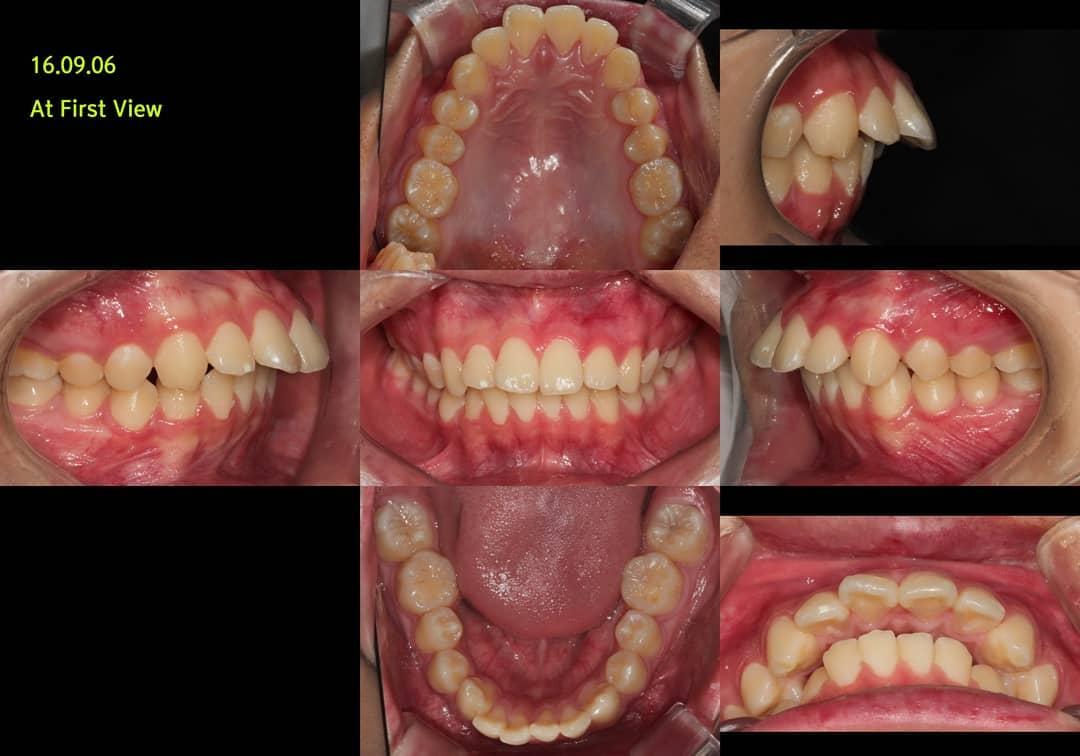 Ext case of severe lip protrusion patient with man…