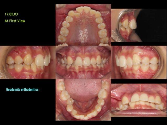 Non-ext treatment of class II Div 2 by using MIs
…
