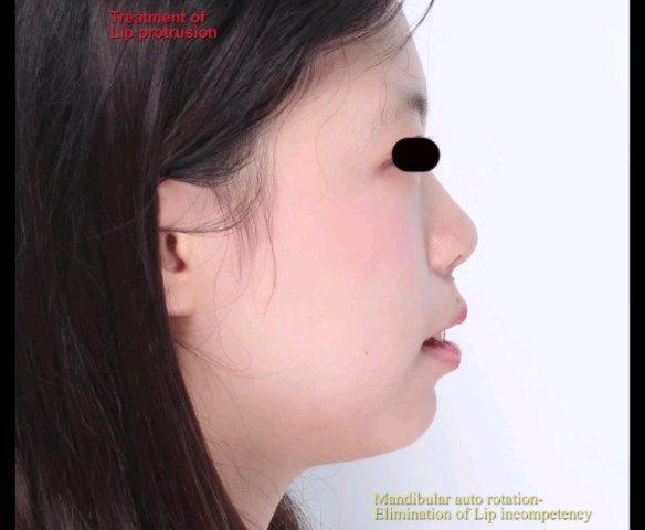 Camouflage treatment of skeletal class II, dental …